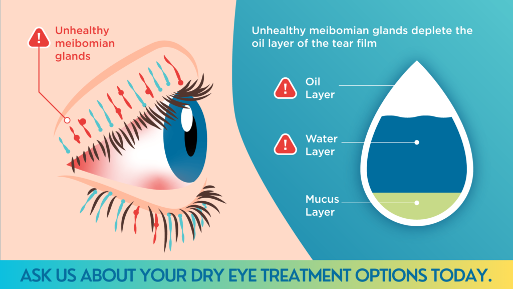 Dry Eye Treatment