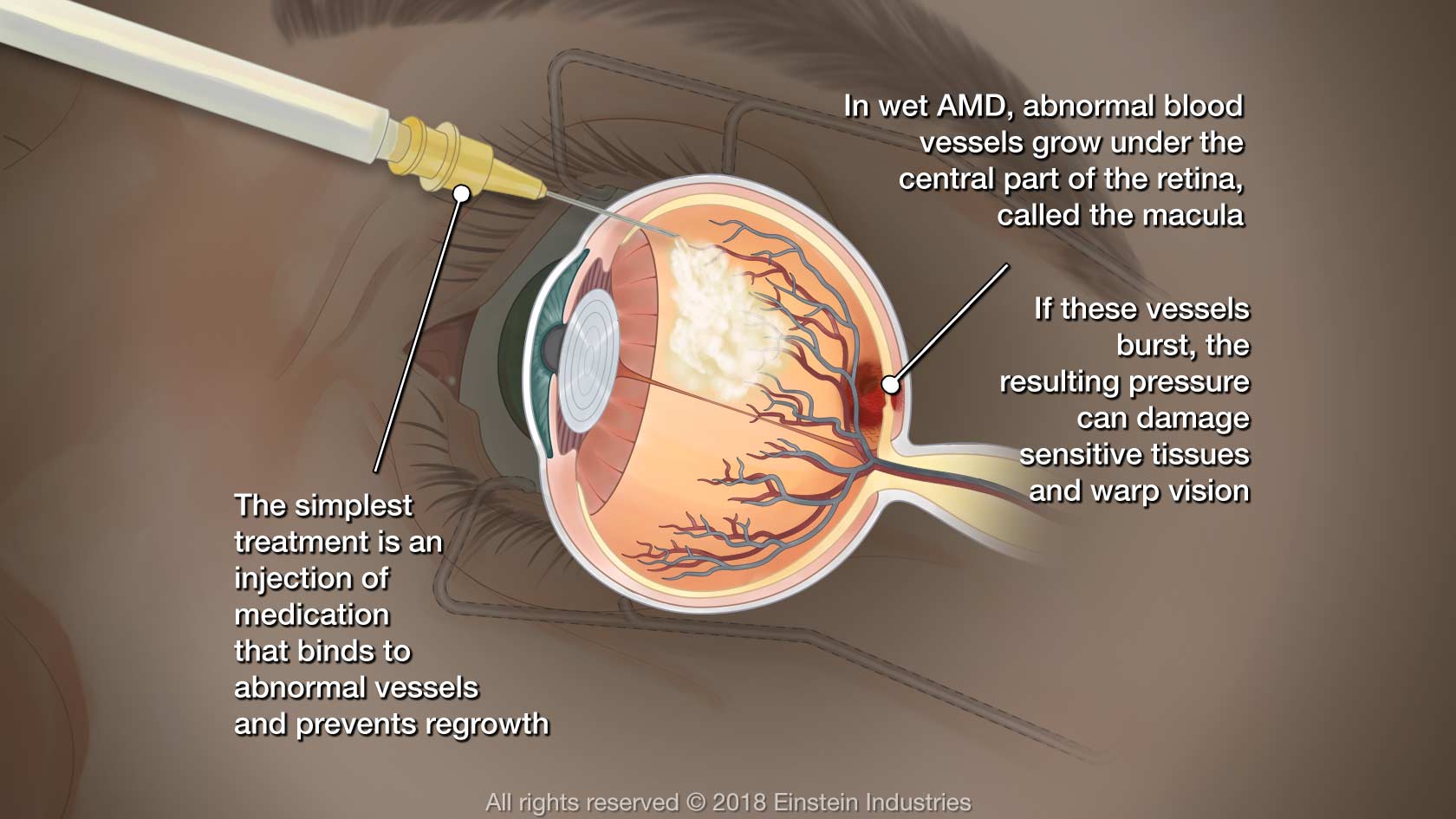 Macular Degeneration Care