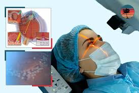 Retina Laser and Surgery